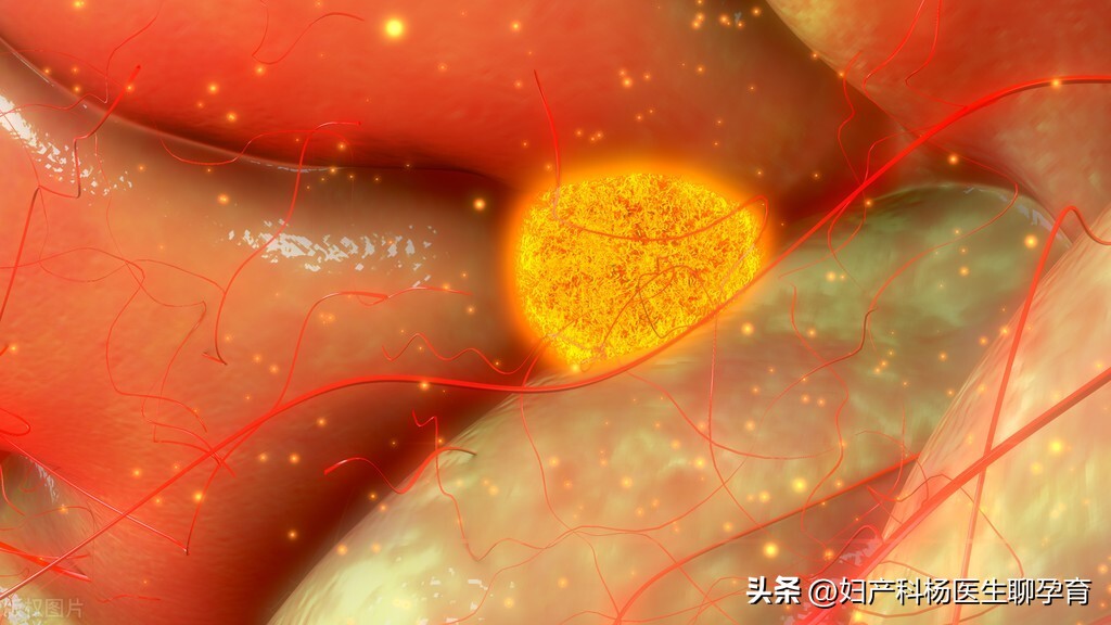 有卵巢囊肿又有多囊卵巢综合征,卵巢囊肿超声检查一般显示什么