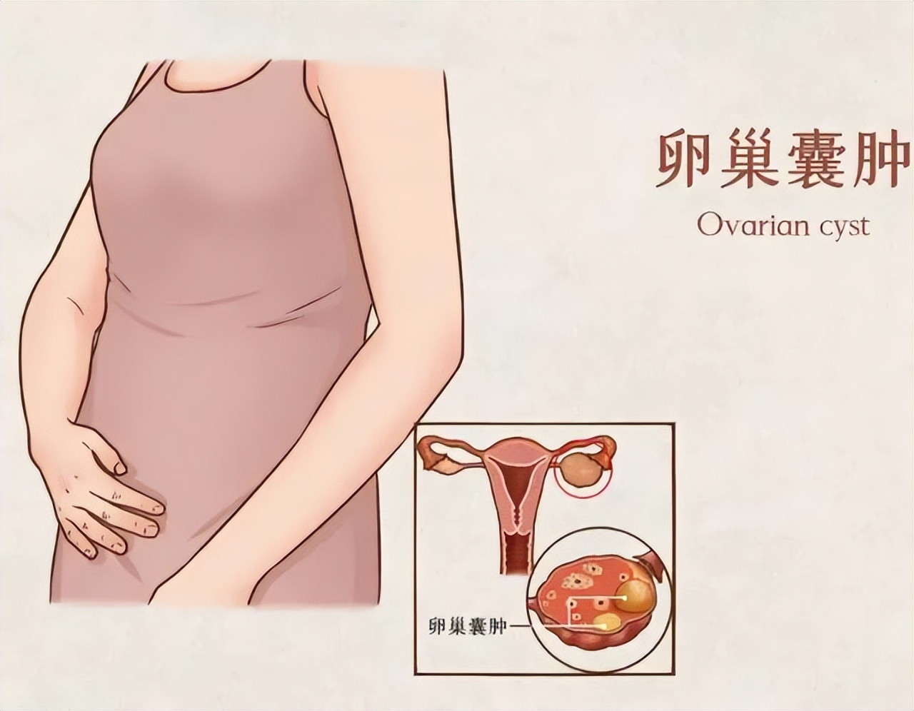 卵巢囊肿声音哑吗,卵巢囊肿小可以不治吗