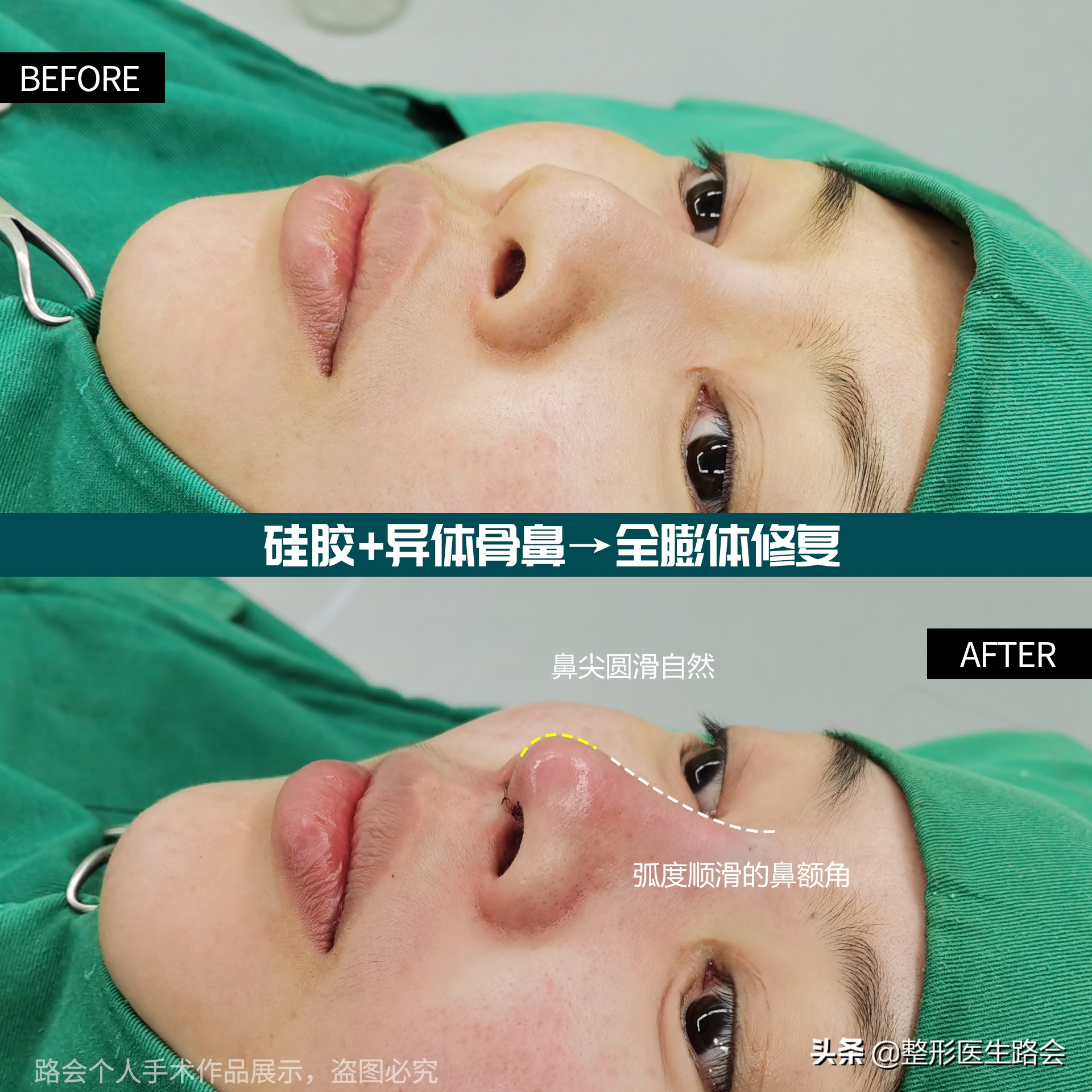 隆鼻失败鼻头有个坑的原因,隆鼻失败导致的鼻头凹陷怎么修复