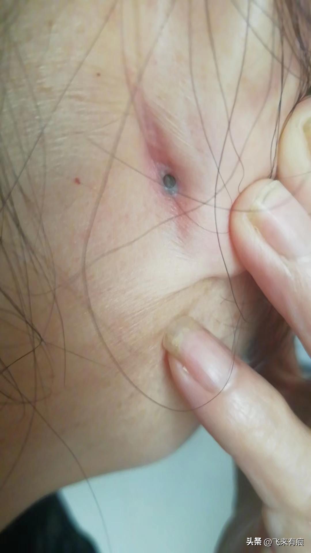 恙虫病科普,今日科普新闻