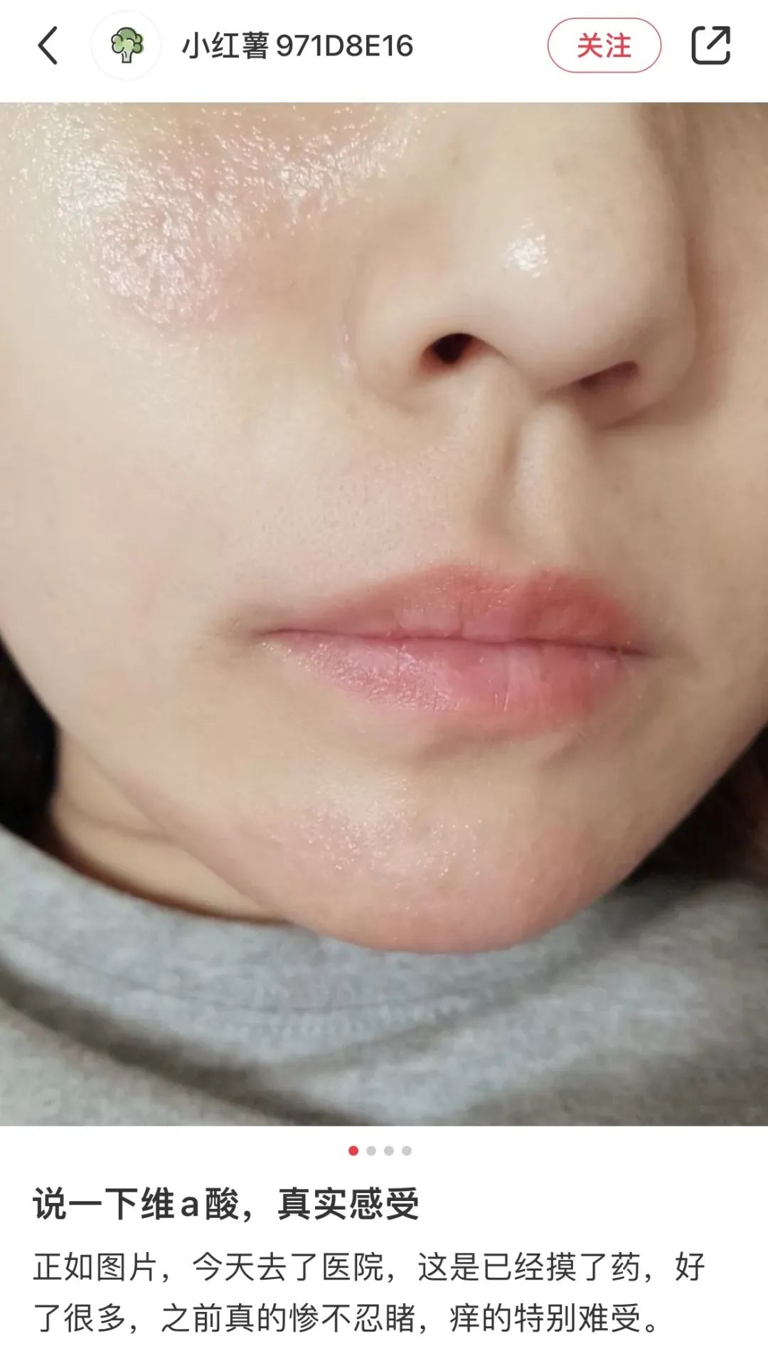 缩毛孔最简单方法,缩毛孔的方法亲身经历