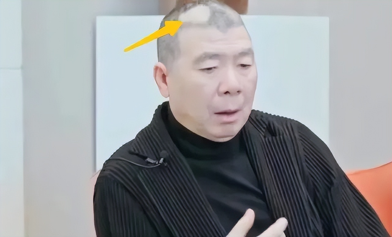 冯小刚白癜风多长时间治愈的,冯小刚的白癜风为什么治不好