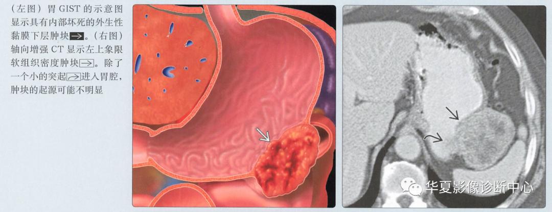 胃肠道间质瘤,胃肠间质瘤tki治疗