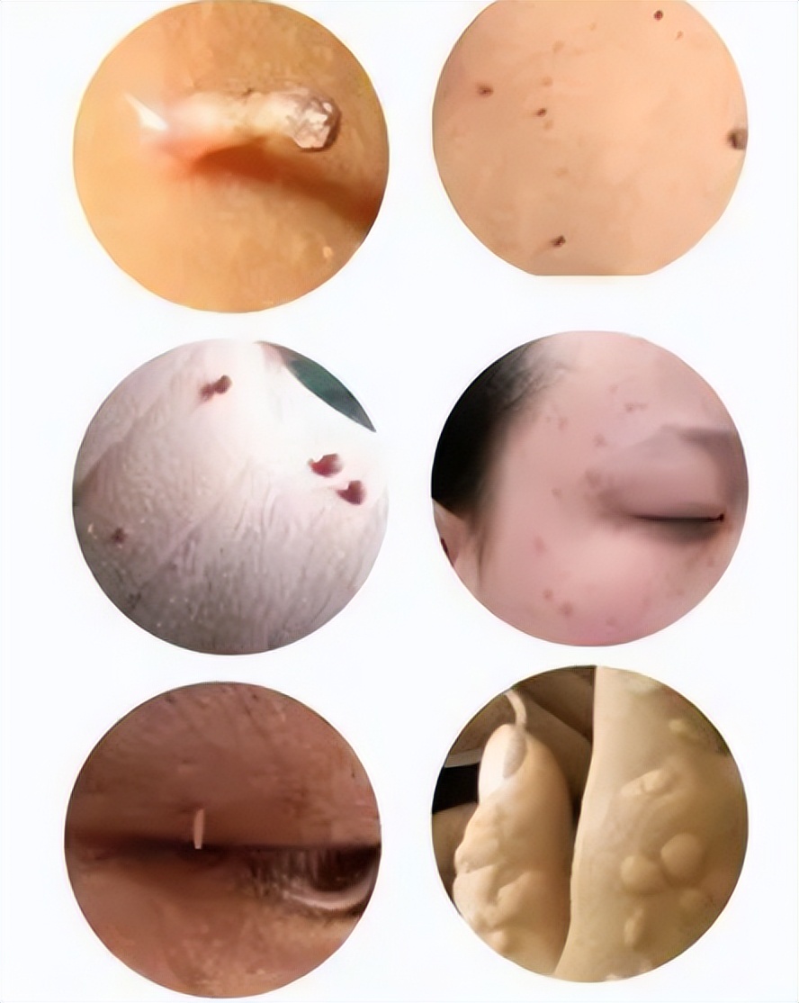 尖锐性湿疣和hpv哪个更严重,尖锐性湿疣是属于hpv高危还是低危