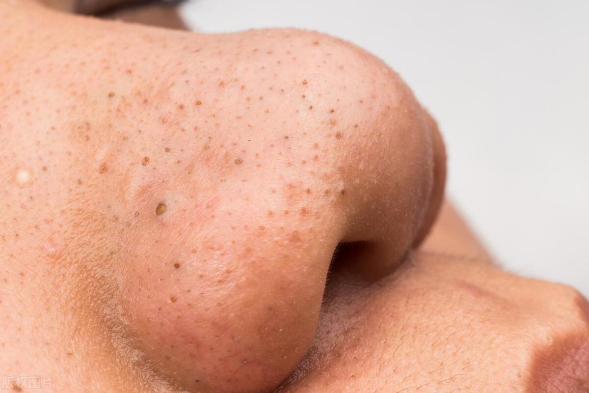 鼻子上的顽固黑头挤不出来怎么办,鼻子上的黑头一直不挤会怎么样