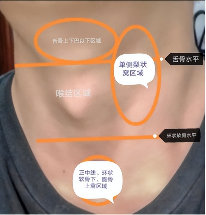 协和耳鼻喉科取鱼刺要多少钱,误吞鱼刺在咽喉多久判断没事