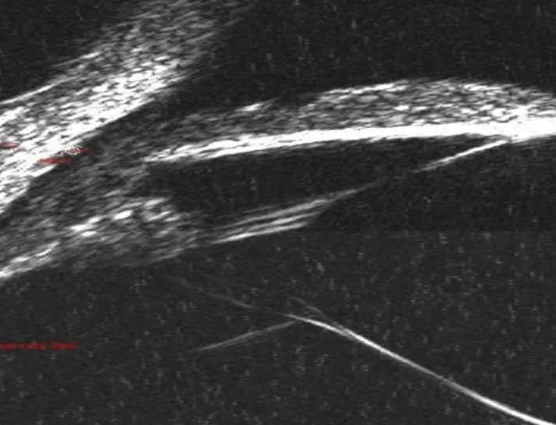 囊袋张力环植入过程,囊袋张力环优缺点
