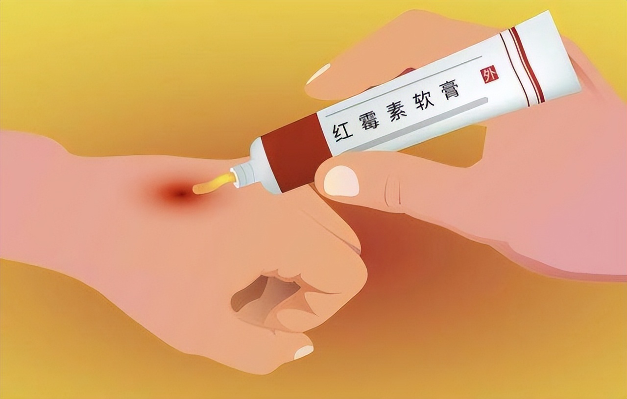 祛老年斑涂抹什么药膏有效,快速消除老年斑的小妙招红霉素