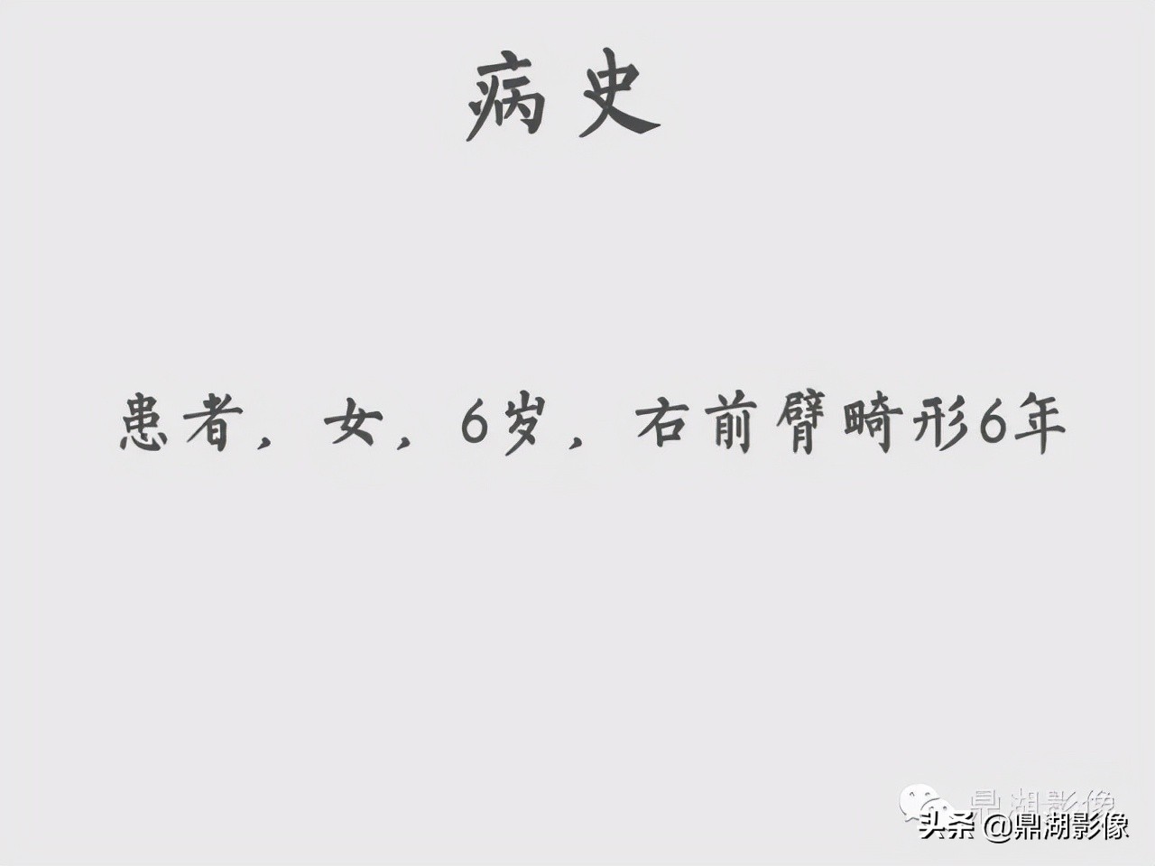 先天桡骨缺失畸形能治疗吗,先天性桡骨发育不良