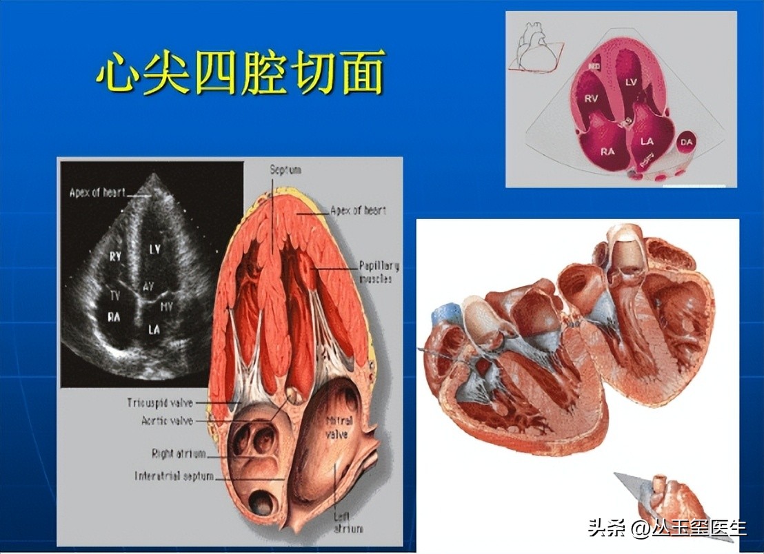 心血管疾病尿毒症,尿毒症最常见的心血管表现