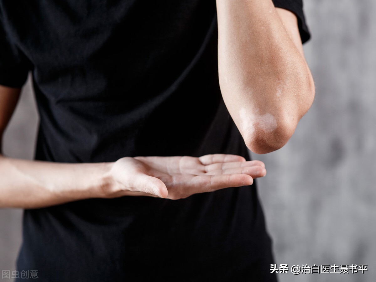 白癜风不痛不痒也不扩散，就真的没有必要治疗吗？