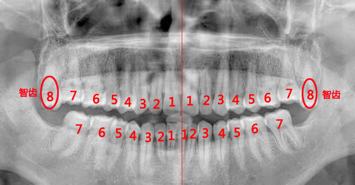 智齿是什么为什么人要长智齿,什么是智齿为什么会长智齿图片