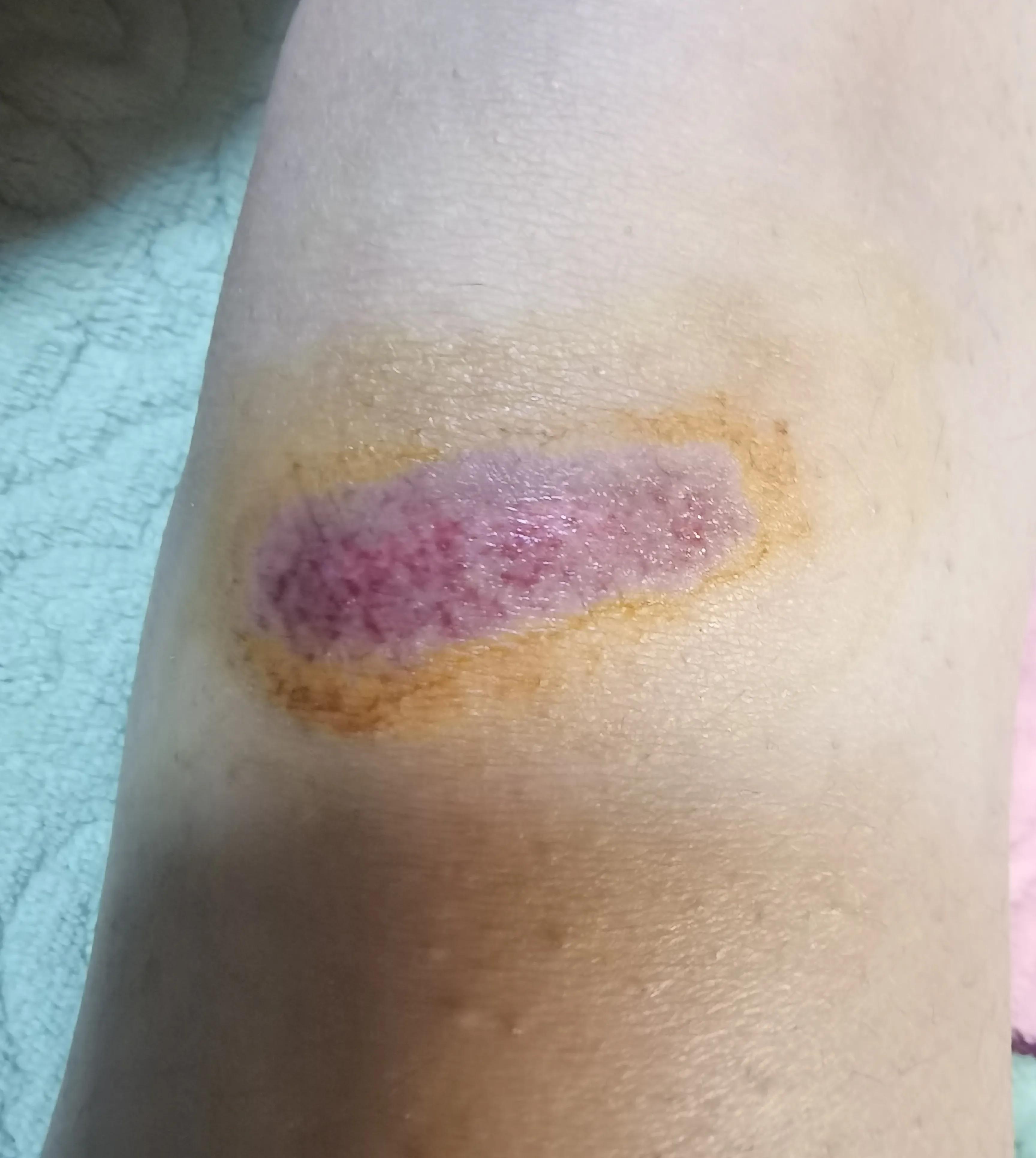 磕伤已经结痂需要做什么处理,擦伤磕伤的正确处理方法