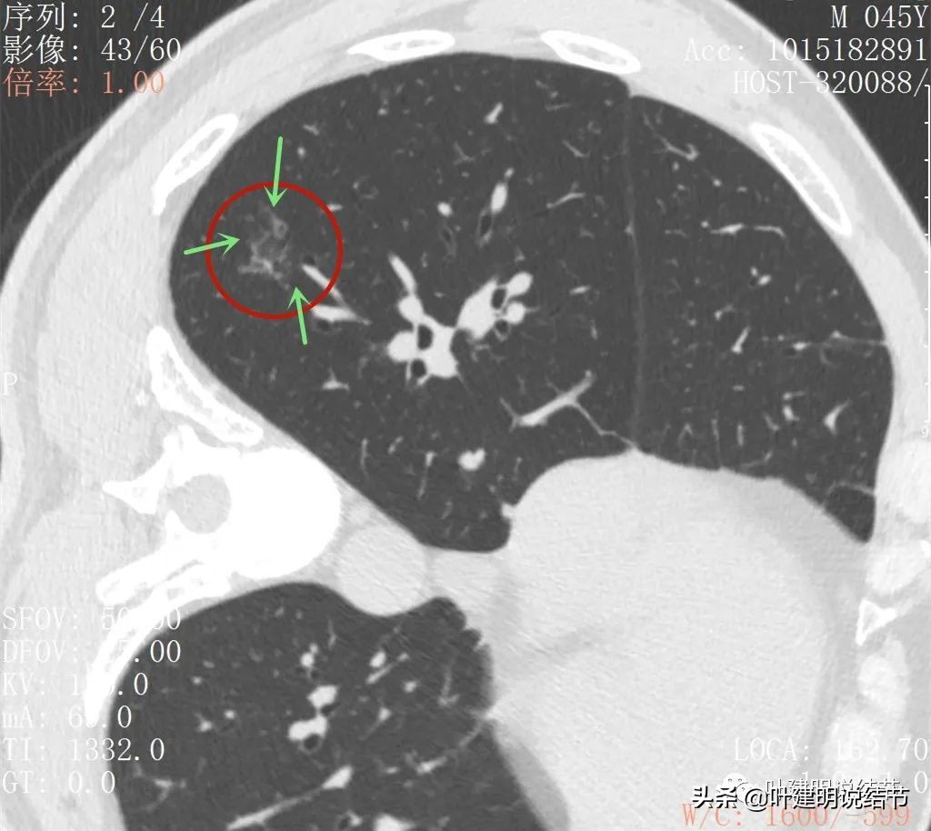 误诊肺纤维化,肺蜂窝状是癌吗