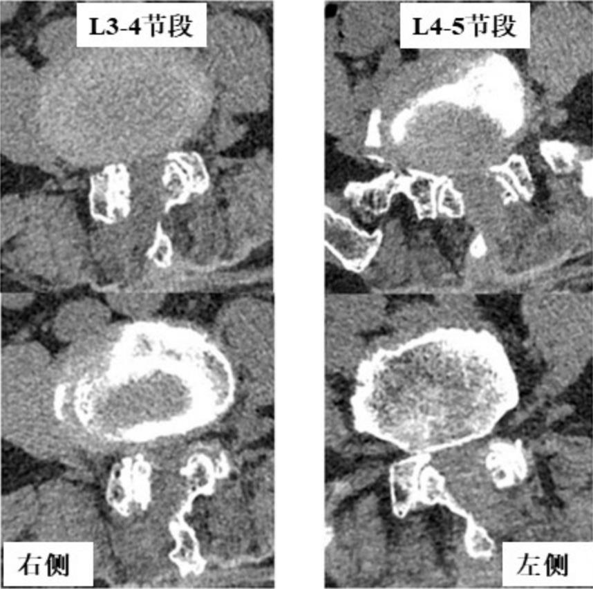 北京友谊医院脊椎手术,北京友谊医院骨科微创手术多少钱