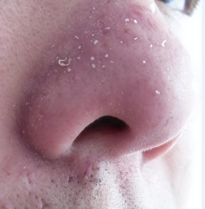 眉心鼻翼和下巴长粉刺为什么,鼻头上起粉刺什么原因引起的图片