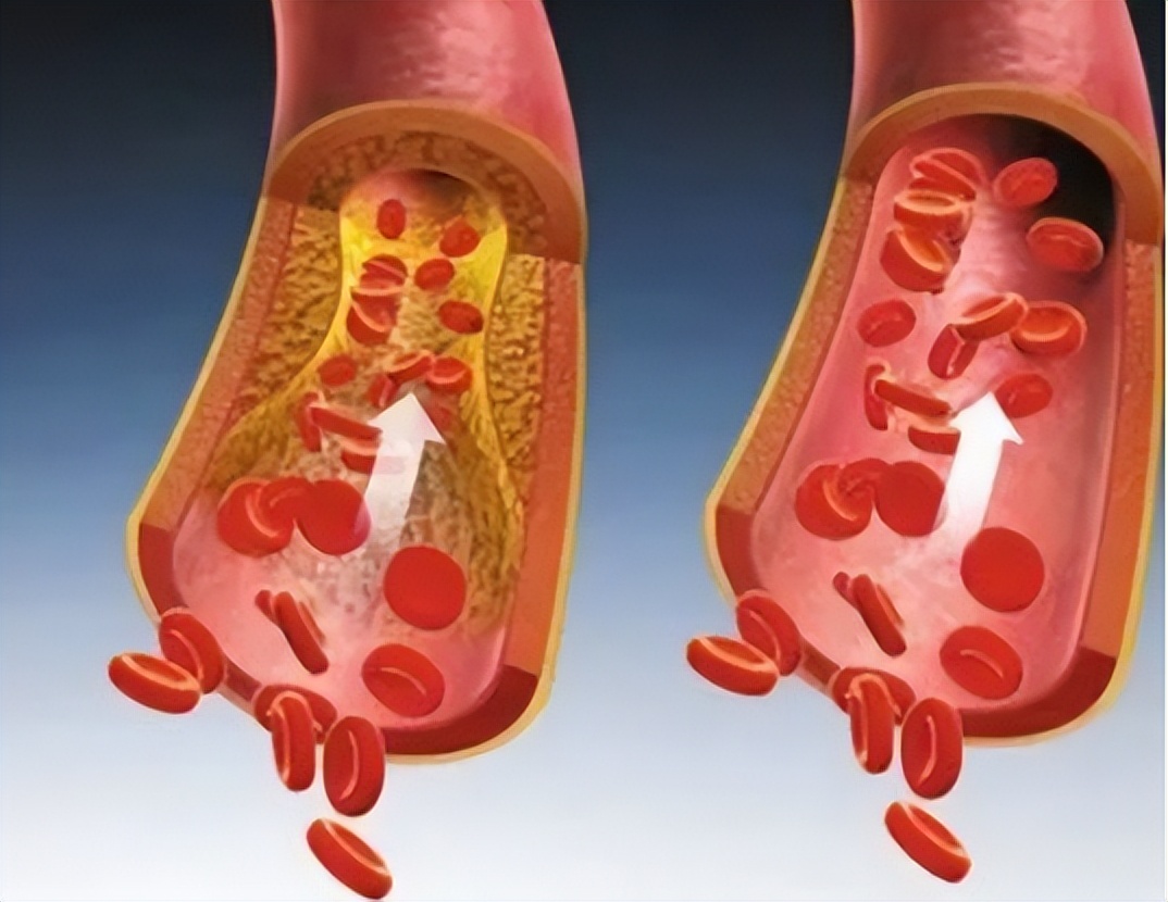 冠心病诊断预测模型,建模预测冠心病
