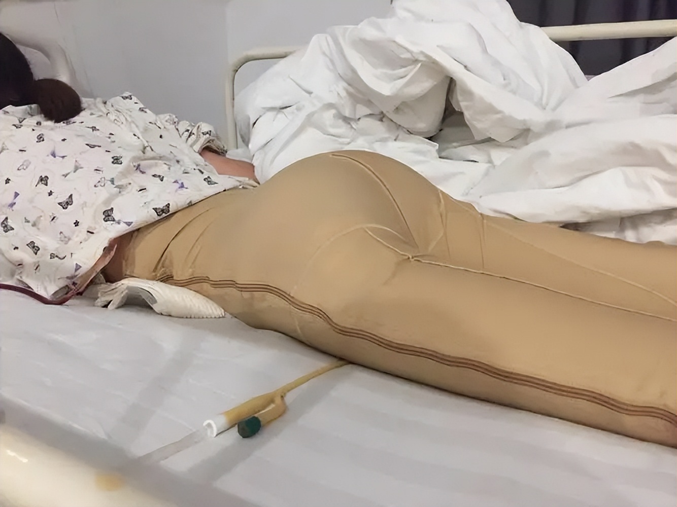 31岁女网红隆臀后高热不退，半边屁股红肿溃烂