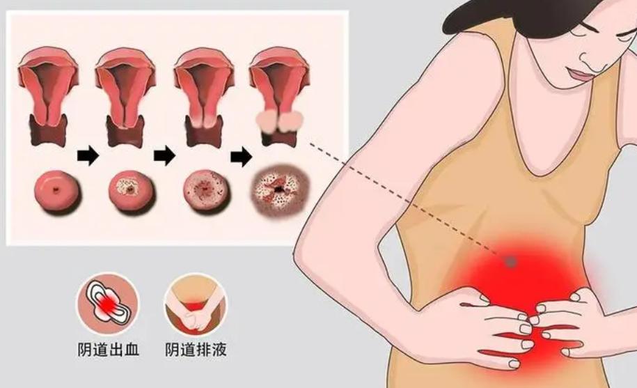 *处私**不规律出血原因很多，最坏的可能会是宫颈癌
