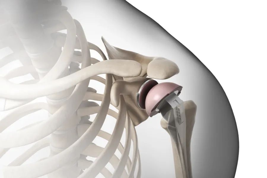 肩关节解剖及常见疾病的磁共振,肩关节常见病图解