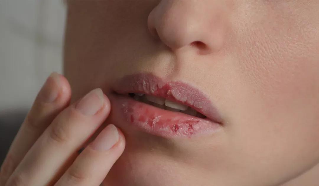 嘴唇干裂起皮不能用舌头舔,唇部一直干裂是怎么回事