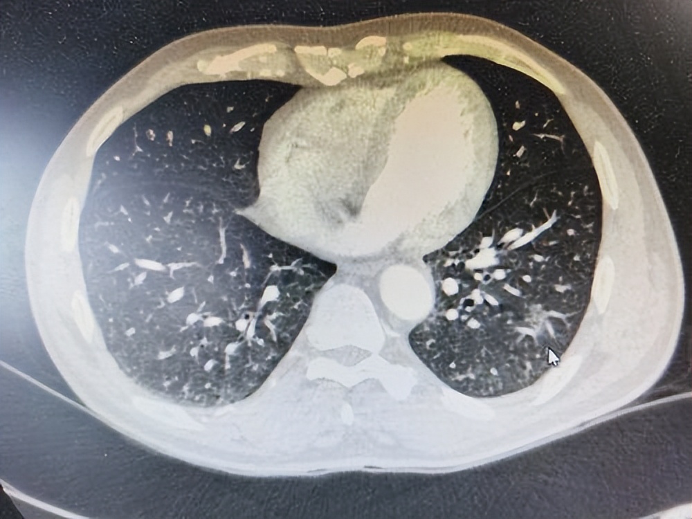 阳康怎么恢复体能,阳康以后恢复元气最快的方法