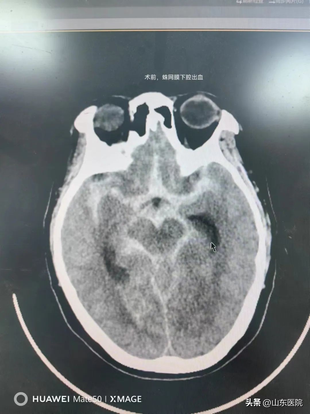 大学城医院神经外科再创奇迹成功拆除患者颅内“定时*弹炸**”