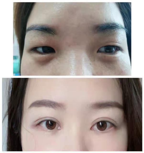 想割双眼皮怕失败,割双眼皮踩雷了应该找医院吗