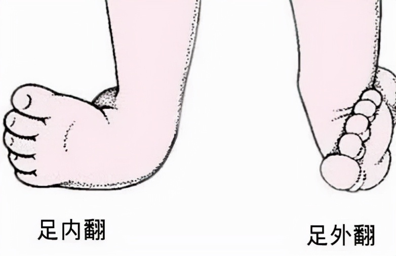 脑瘫肢体畸形怎么描述,针刀治疗脑瘫肢体畸形