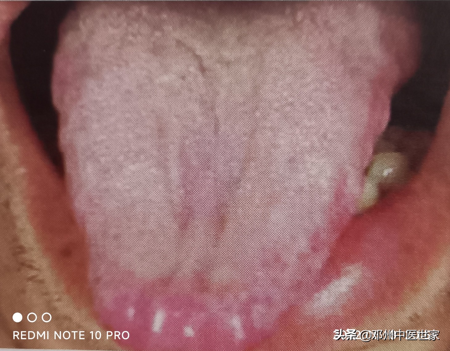 黄疸舌象,黄疸舌苔发黄