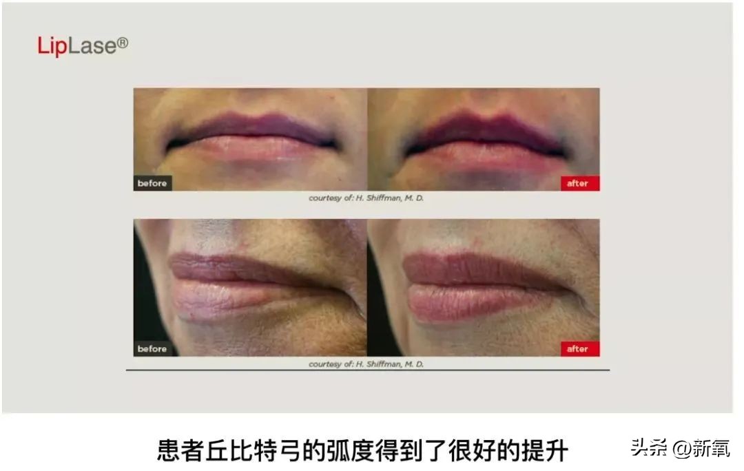 嘴唇薄变丰满,嘴唇变凸变丑怎么办