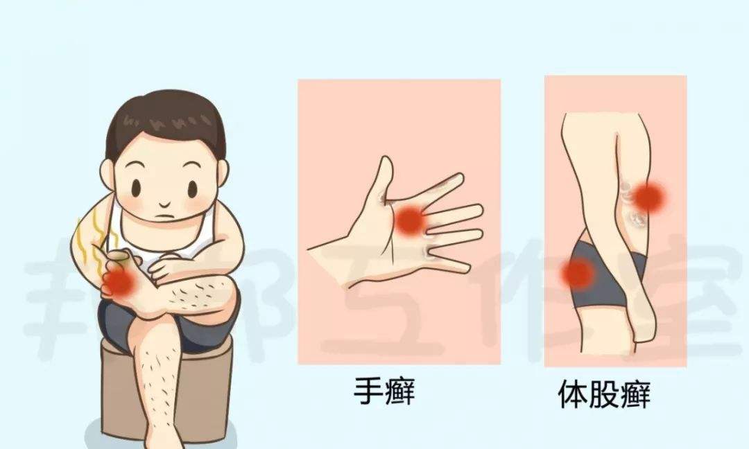 手足癣怎么治疗最有效,手足癣怎么治疗最快最有效