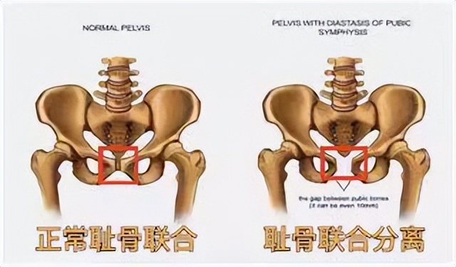 【科普】孕期、产后腰痛，当心这个病！新手宝妈痛到“瘫痪”