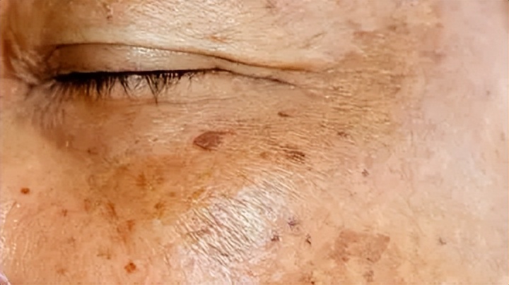 老年色素沉着斑怎么消除,色素沉着老年斑能去除吗