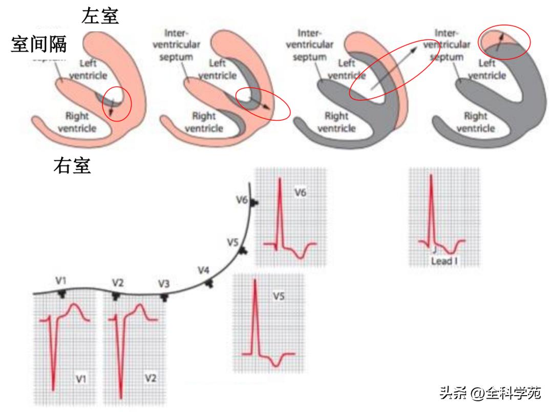 心电图笔记26：QRS波振幅变高，需要想到哪些