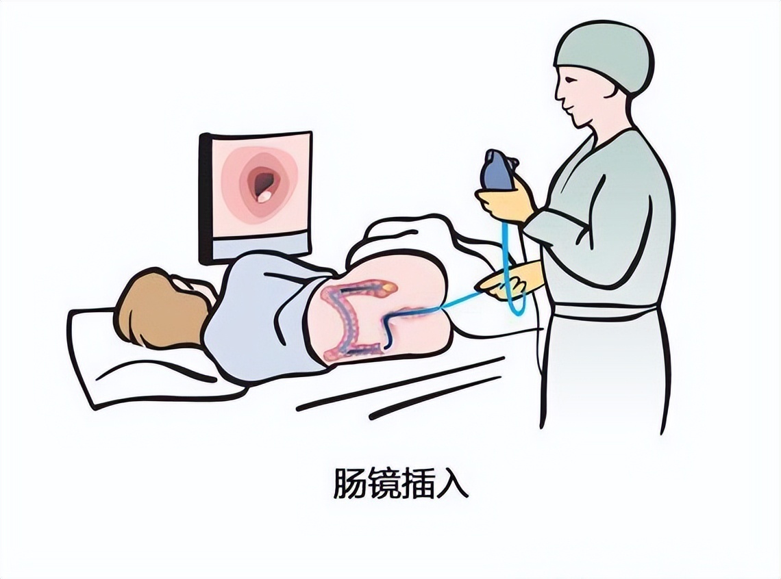 一次正常的肠镜可以确保多久,肠镜一次到底可以管多久