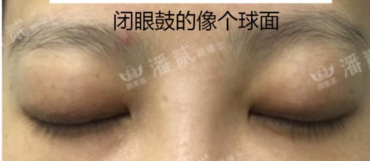 凸眼球显得眼睛大,凸眼眼窝凹陷