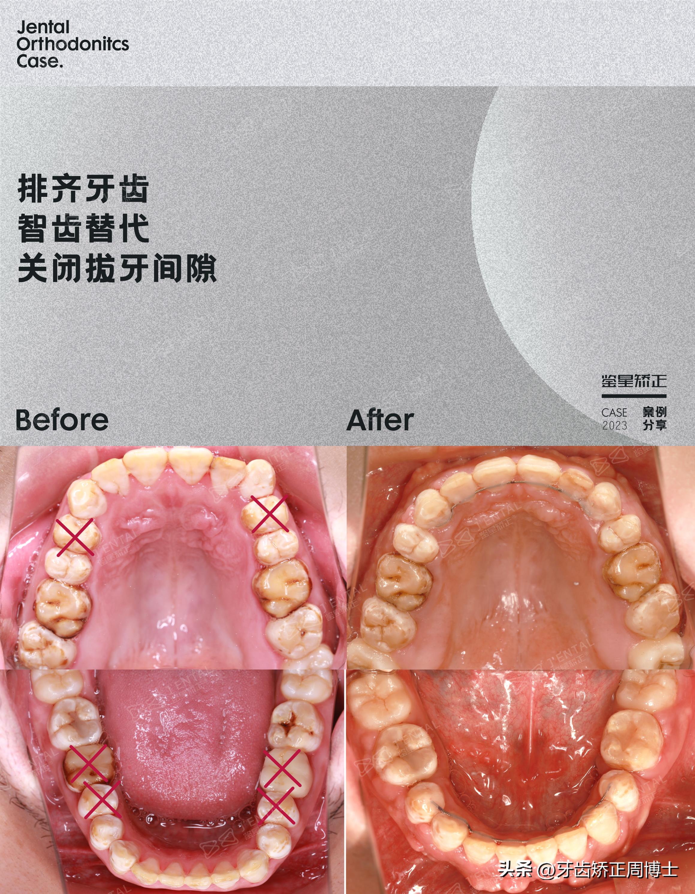 智齿正畸替代第二磨牙危害,智齿矫正代替第二磨牙3d图