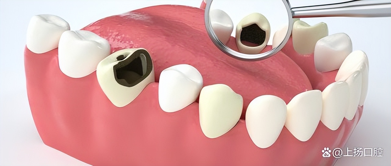 为啥补完牙会牙疼,为啥补完牙会有异物感