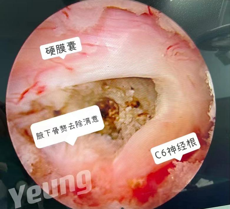 西安椎间孔镜手术治疗颈椎,西安红会医院微创
