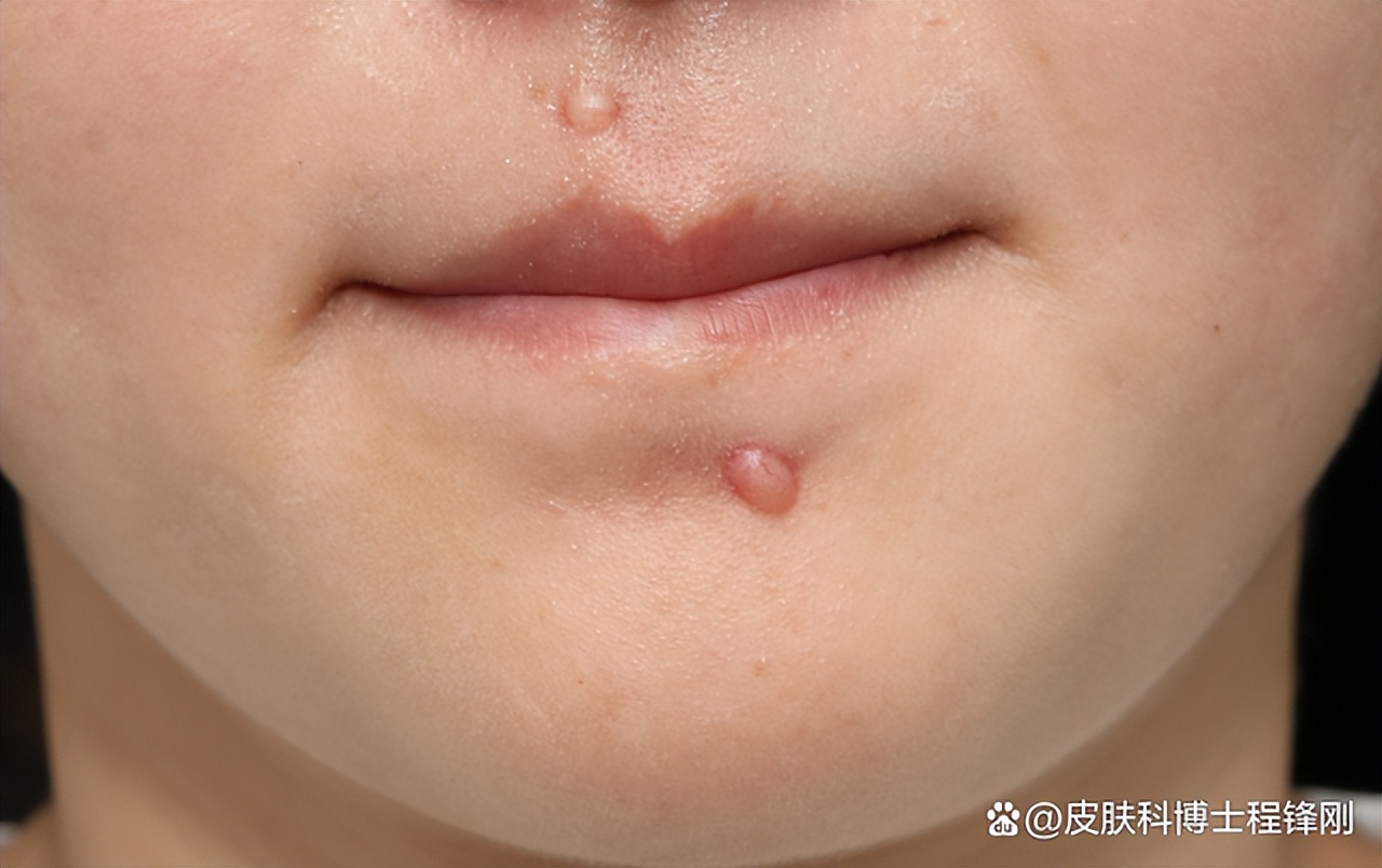 祛痣了怎么会长出肉疙瘩,祛痣之后长出了红痘还能好吗