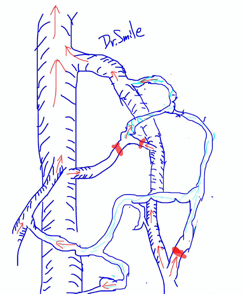 静脉曲张可以根治吗,静脉曲张能治好吗