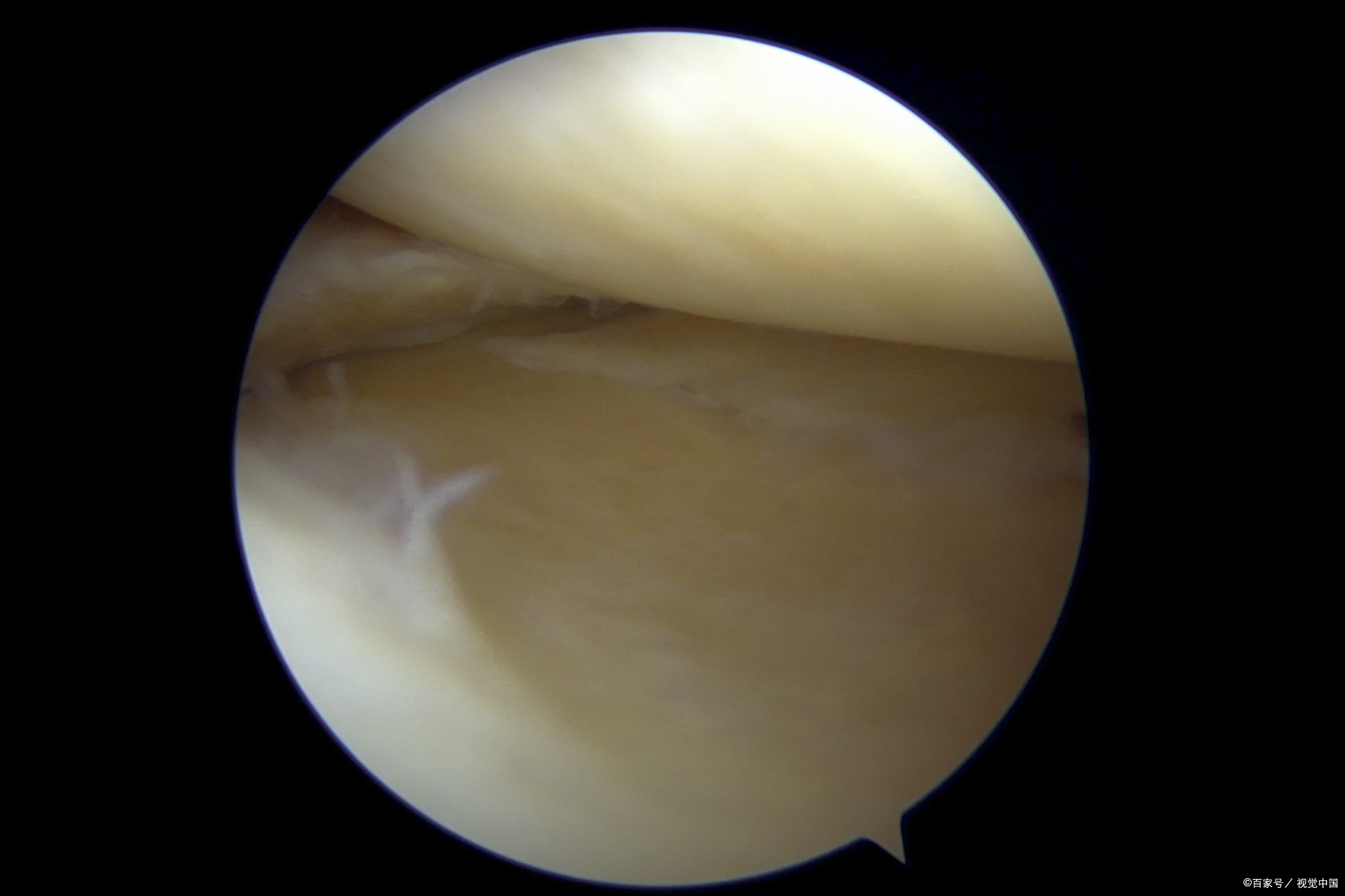 2级半月板损伤,2级半月板损伤的最好治疗