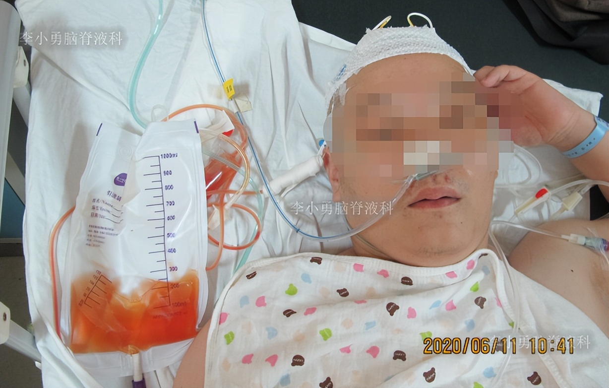 脑积水三脑室造瘘多久能恢复,脑囊虫手术后脑积水