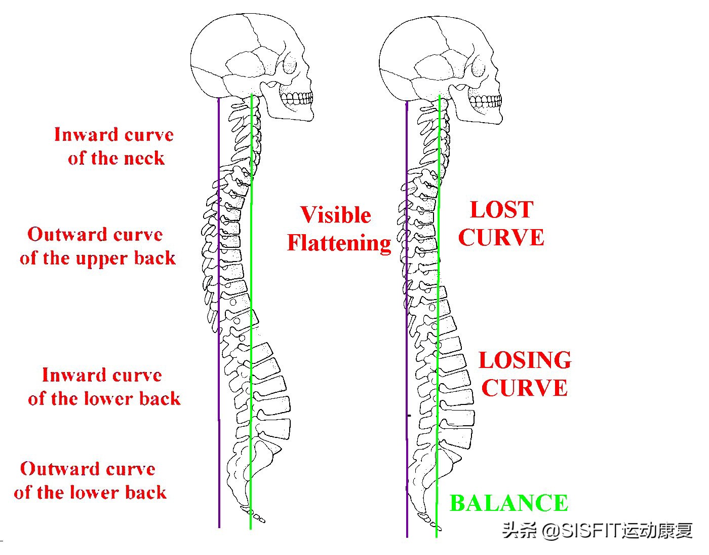 腰椎曲度变直的5个康复训练,腰椎曲度变直康复训练