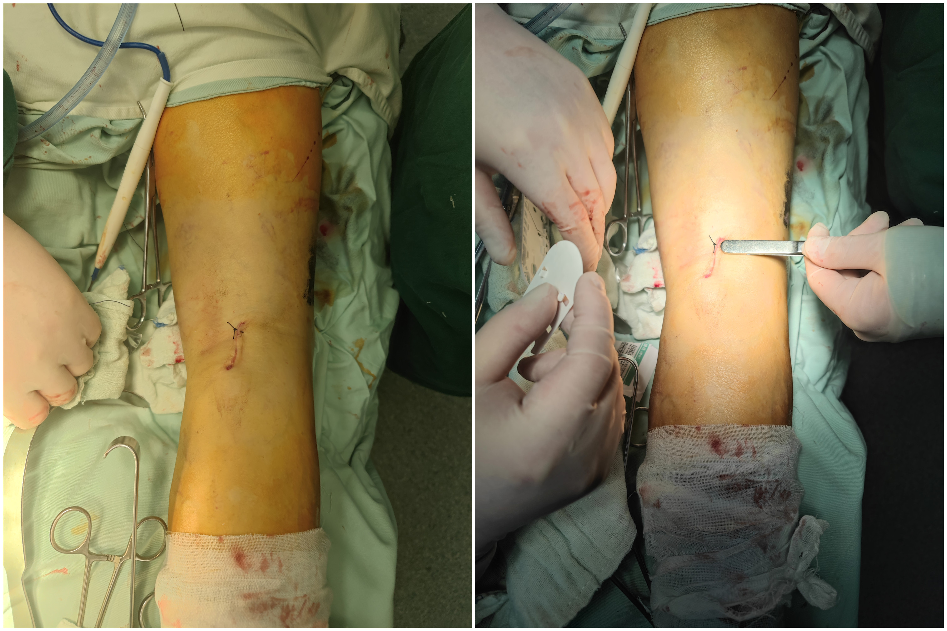 骨伤微创手术,黄梅县中医医院骨伤一科