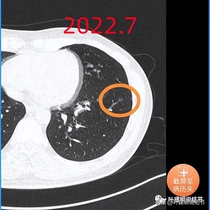 肺部结节医生建议抗炎后复查,放射科医生查出肺结节
