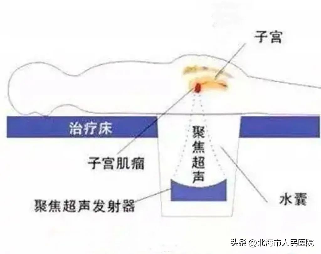无创海扶刀,海扶无创消融苏州有吗