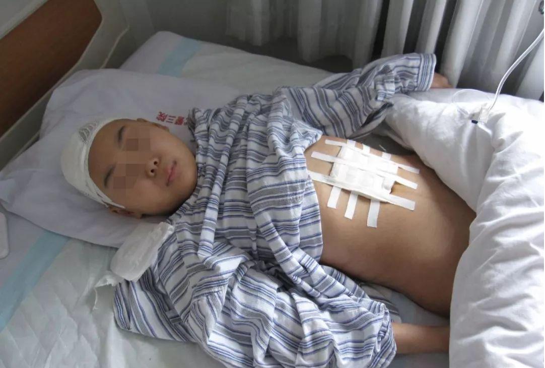 儿童结核脑膜炎脑积水,结核性脑膜炎脑积水如何引起