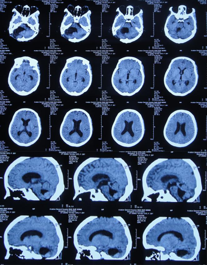 听神经瘤出现脑积水和出血,听神经瘤手术后颅压高症状